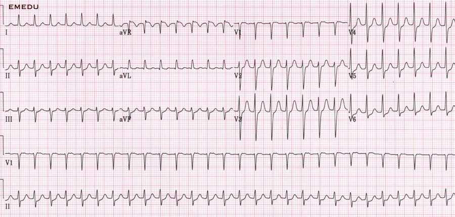 ekg practice test free with answers