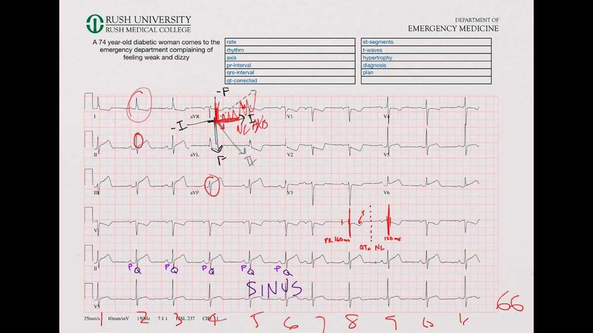 cleveland clinic ekg test answers