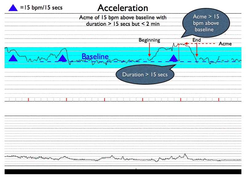 awhonn advanced fetal monitoring test answers