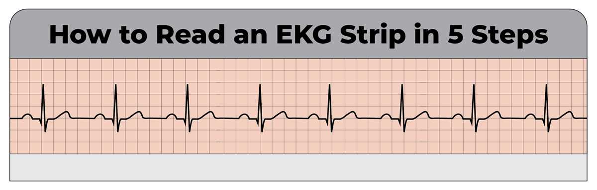 healthstream ekg test answers