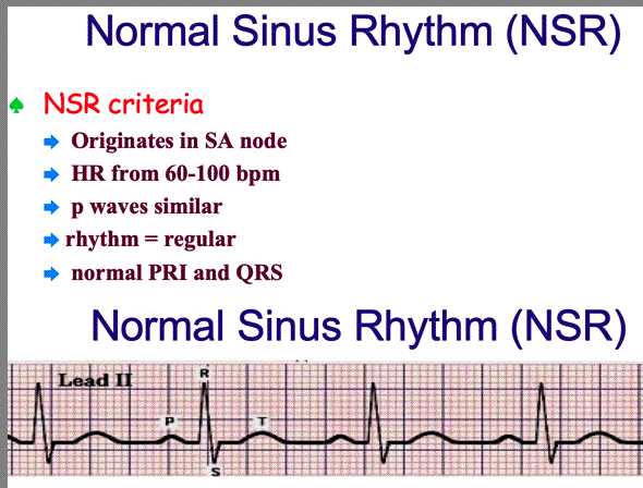 upstate medical university ekg rhythm interpretation exam answers